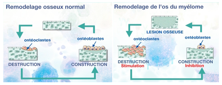 Remodelage osseux normal - Remodelage de l'os du myélome